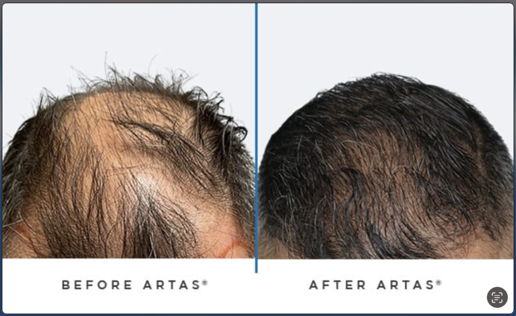 Artas Hair Transplant