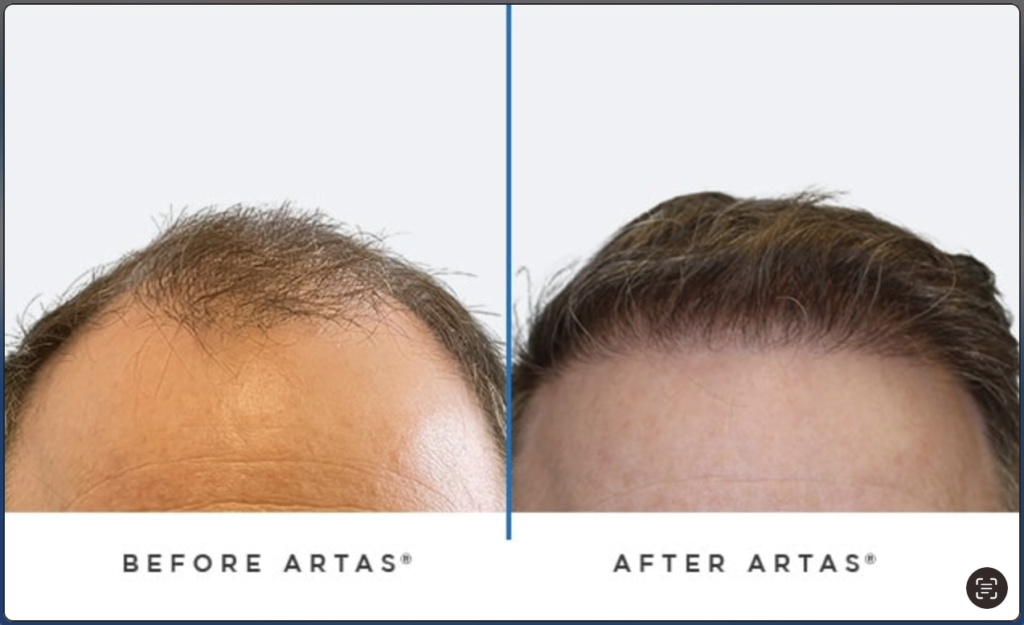 Before Atras & After Artas