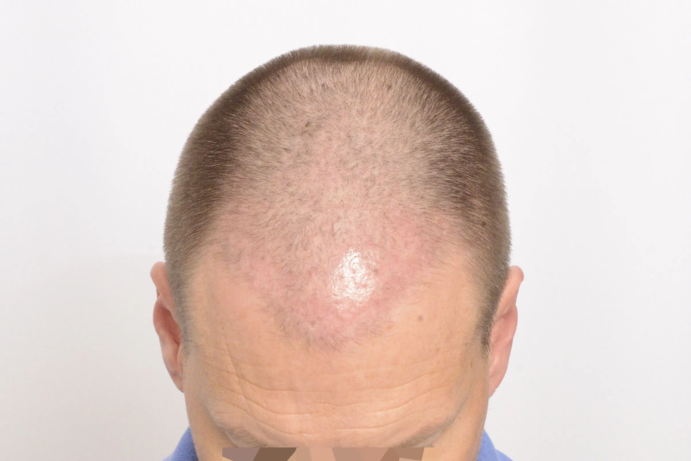 SpartanMD | Hair Transplantation