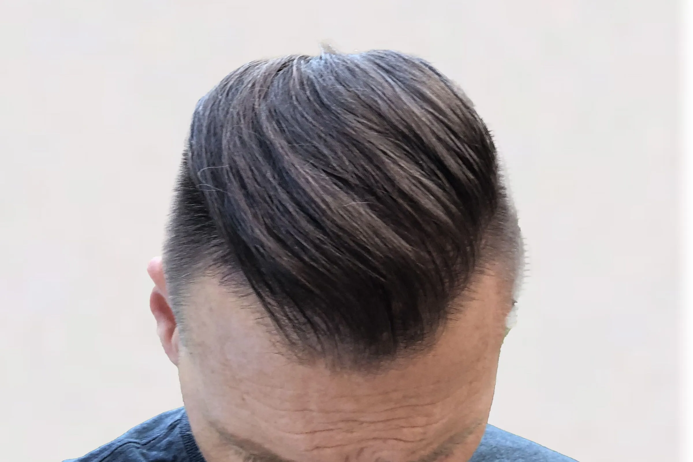 SpartanMD | Hair Transplantation