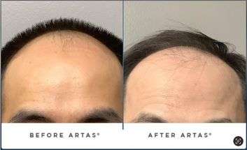 SpartanMD | Non-Surgical Hair Rejuvenation