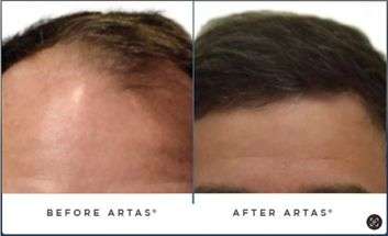 SpartanMD | Non-Surgical Hair Rejuvenation