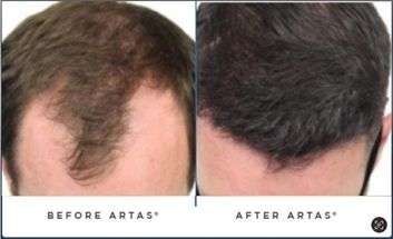 SpartanMD | Non-Surgical Hair Rejuvenation