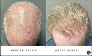 SpartanMD | Non-Surgical Hair Rejuvenation
